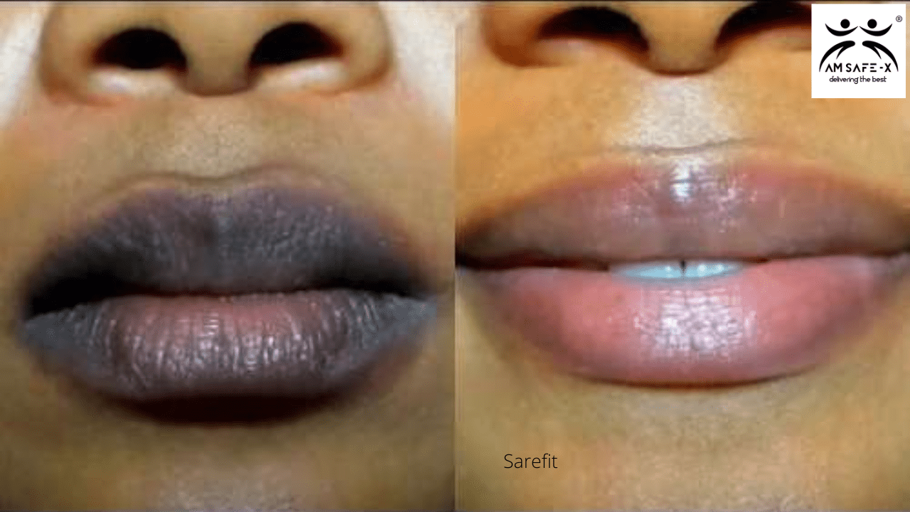 Dark lips